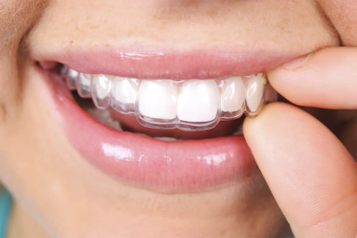 Invisalign®