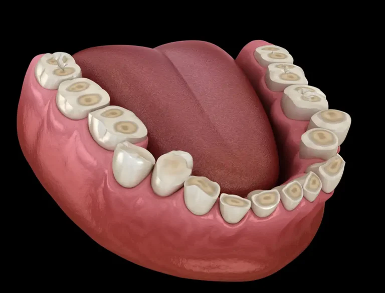 The Hidden Damage Caused by Teeth Grinding and How It Can Be Treated.