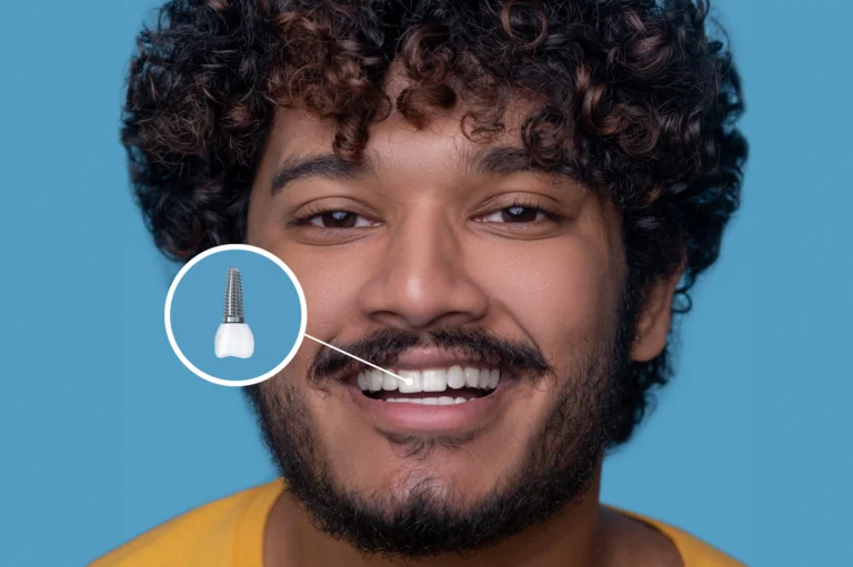 Restore Your Smile for Life: The Power of Dental Implants.